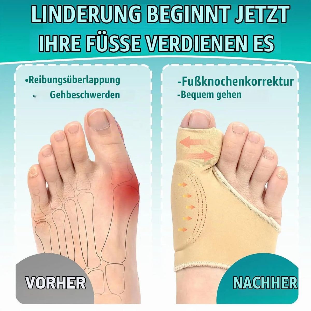 Nogavice za Hallux Valgus z Gel Blazinico, 2 Kosa